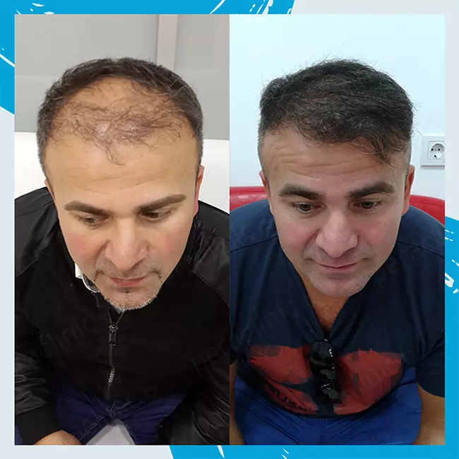 Hair Transplant