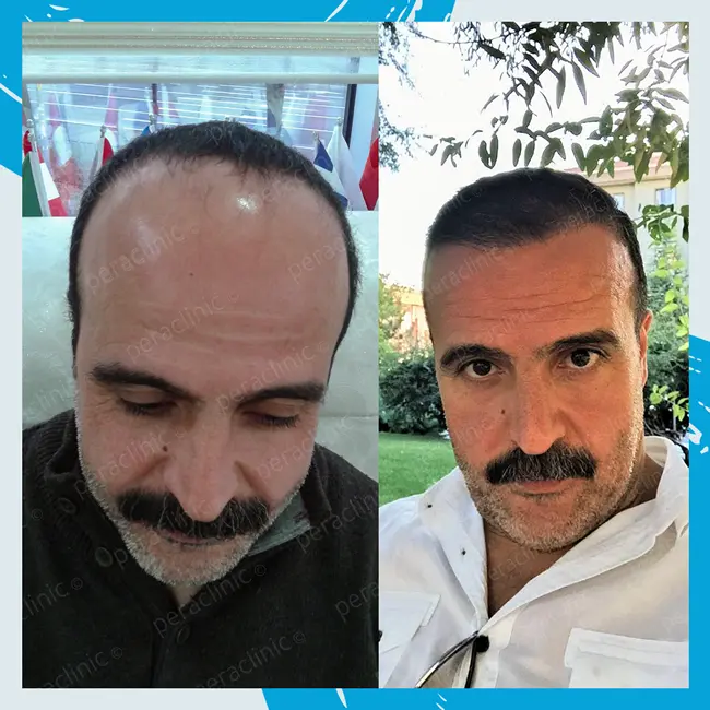 Hair Transplant